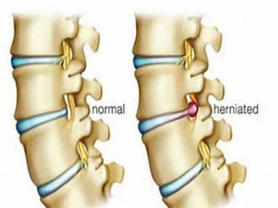 Back Pain & Sciatica
